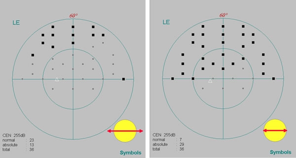 How To Fail Visual Field Test For Blepharoplasty?